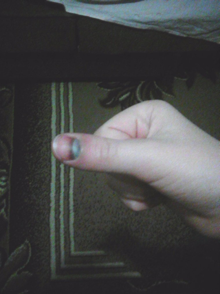 Подногтевая меланома мизинца