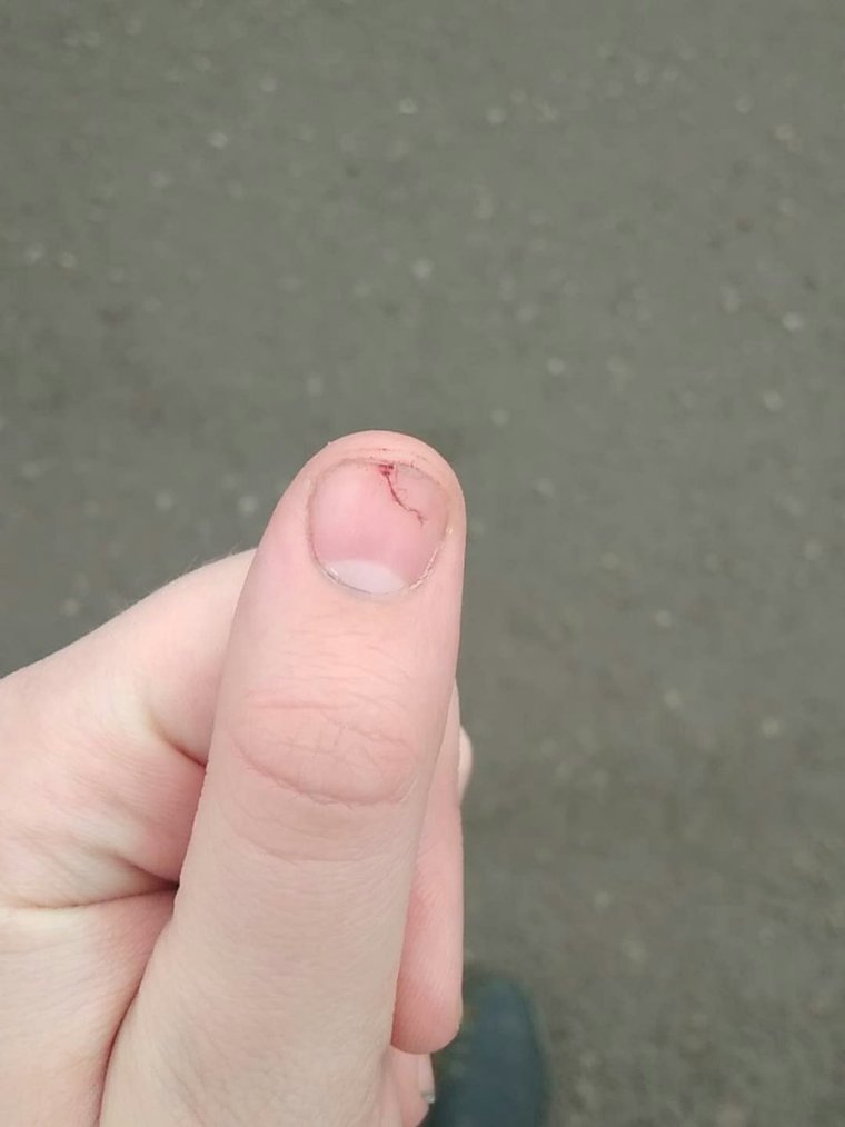 Прищемила палец дверью машины