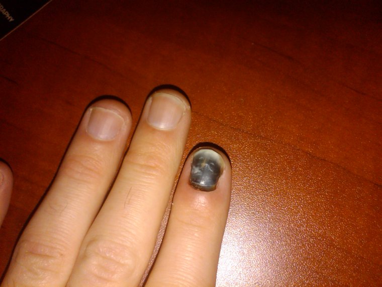 Подногтевая гранулема