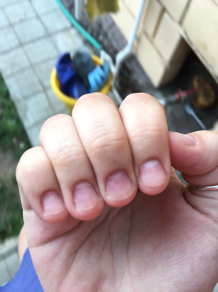 Ноготь отходит от кутикулы