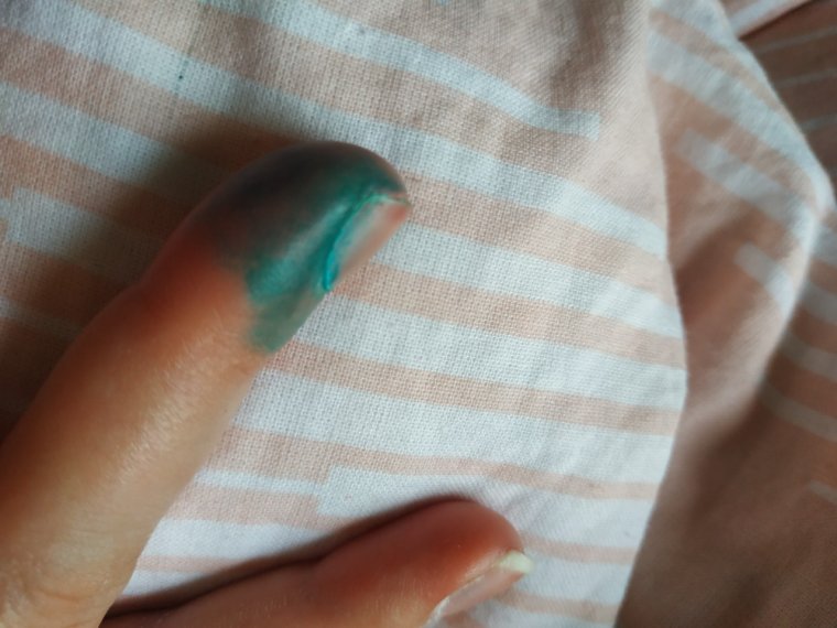 Околоногтевая бородавка