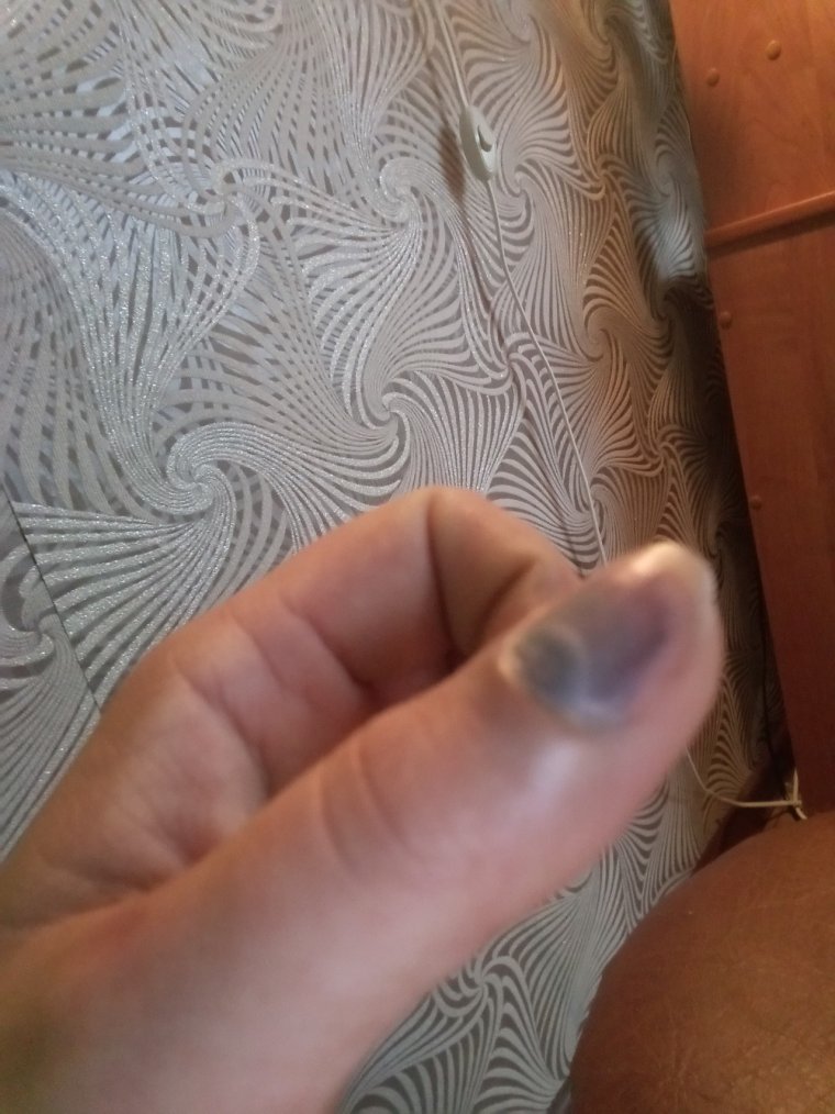 Прищемил большой палец