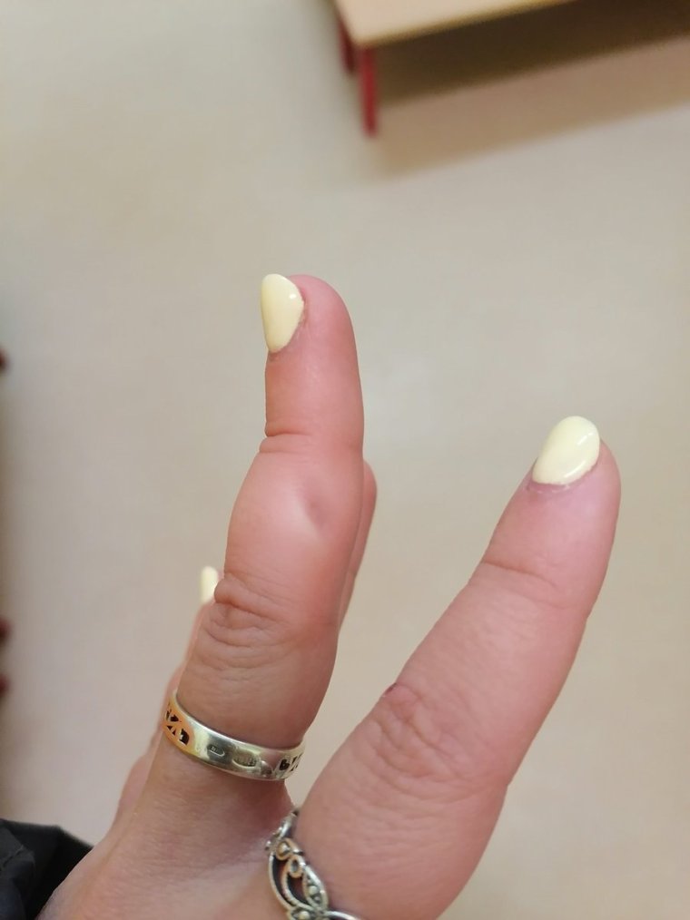 Отхождение кутикулы на ногте