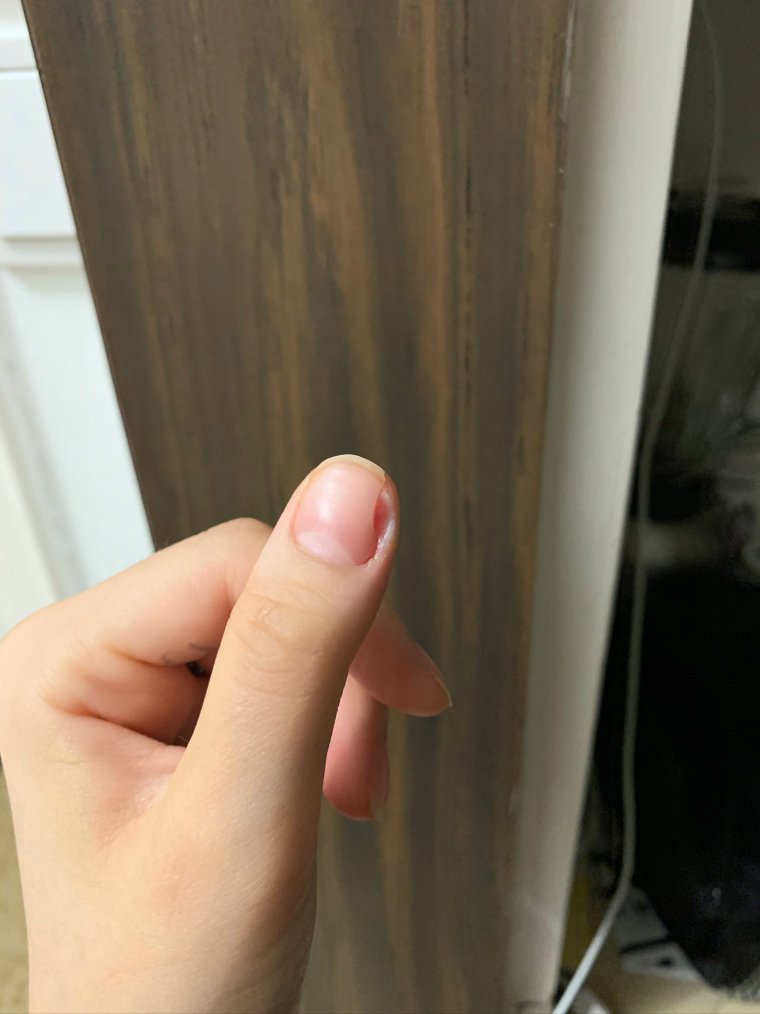 Сильный ушиб ногтя на руке