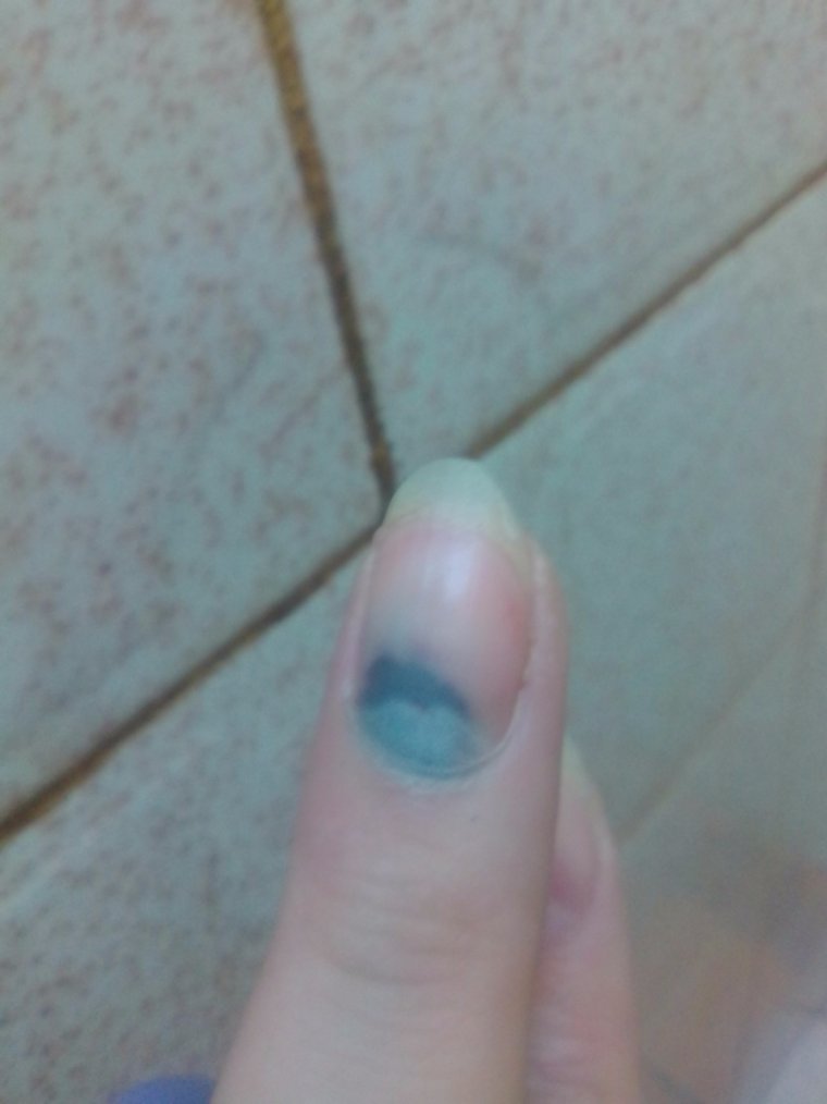 Прищемила палец дверью машины