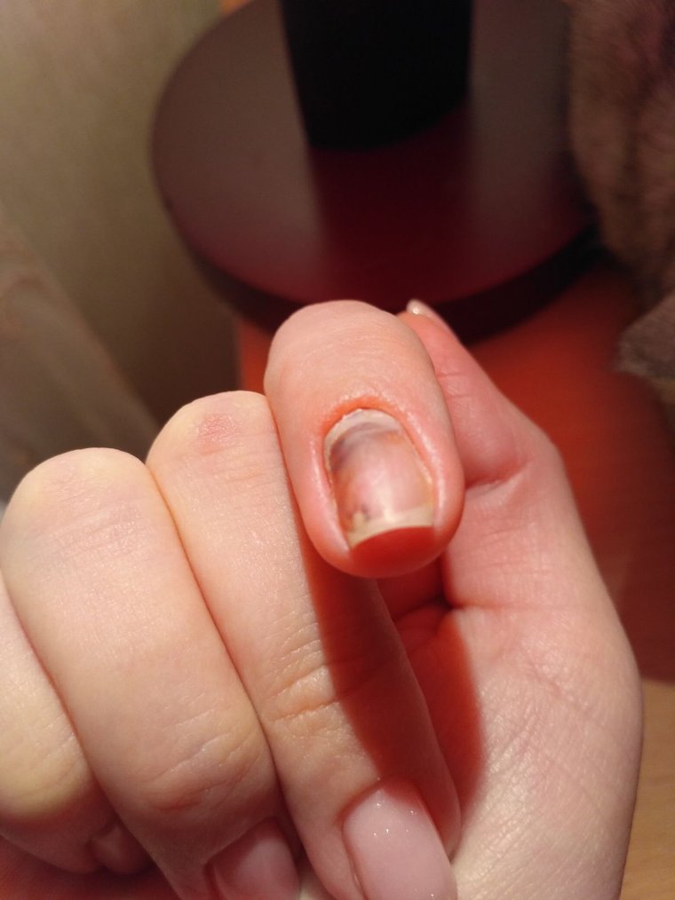 Ребенок прищемил палец