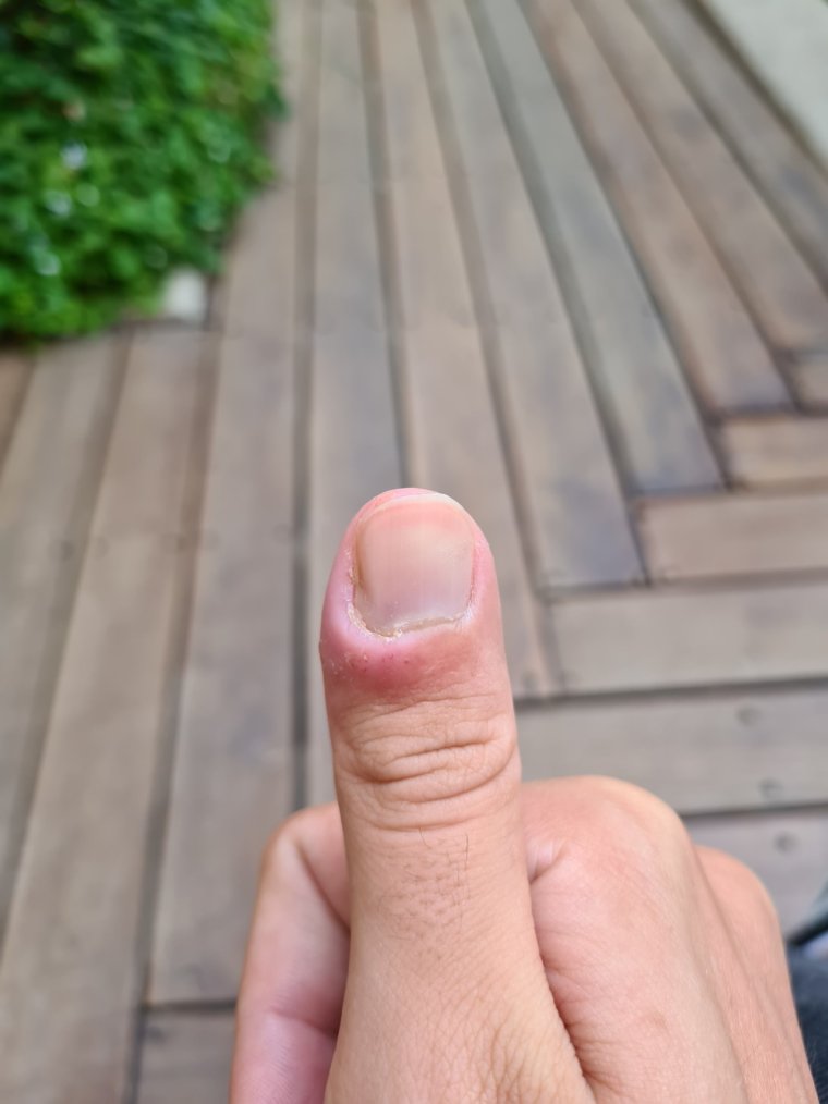 Маникюр на прищемленный палец