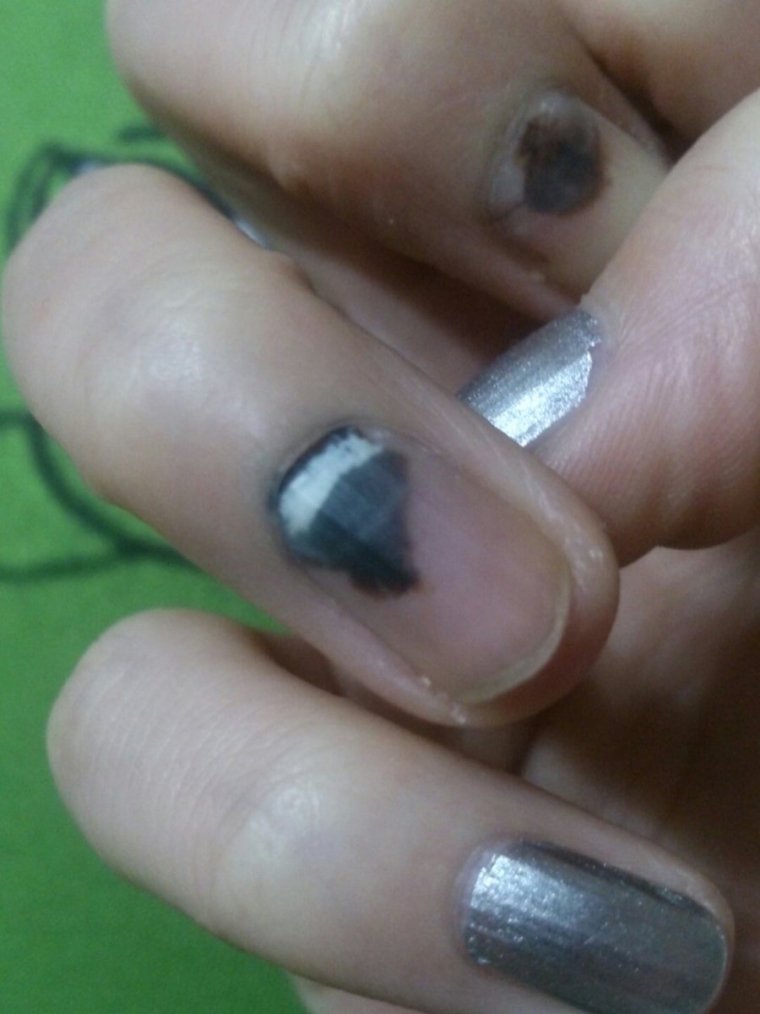 Маникюр на прищемленный палец