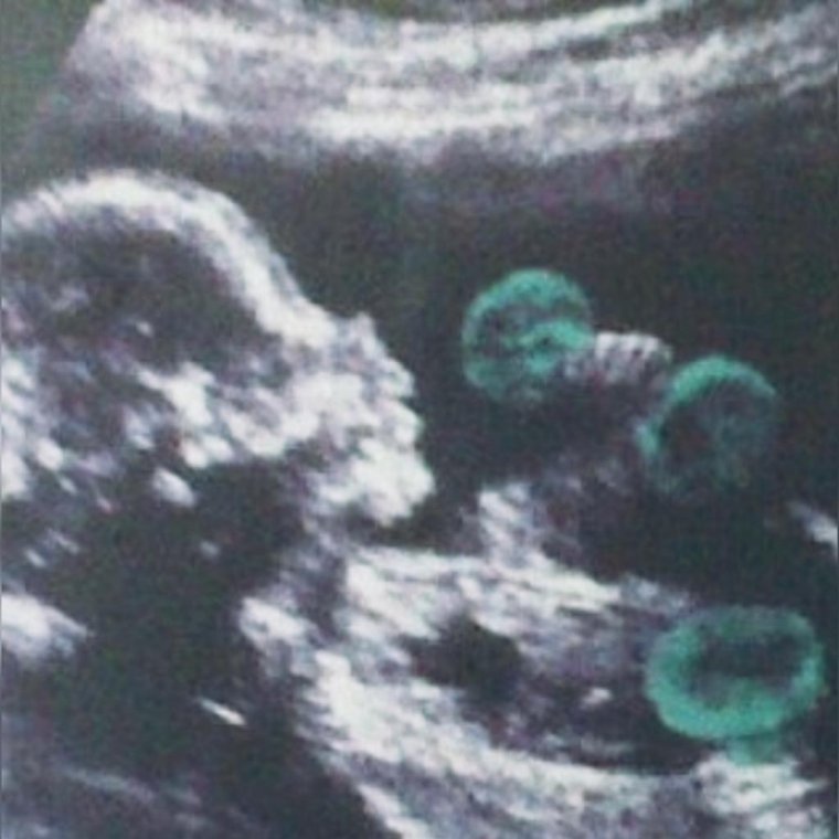 УЗИ приколы