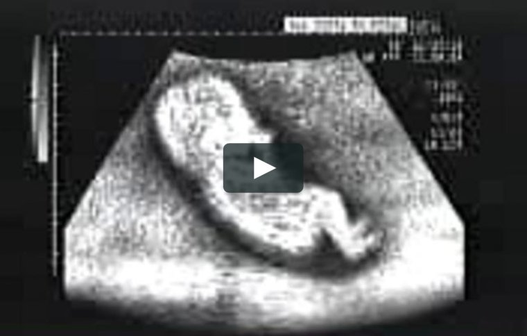 Преимущества УЗИ