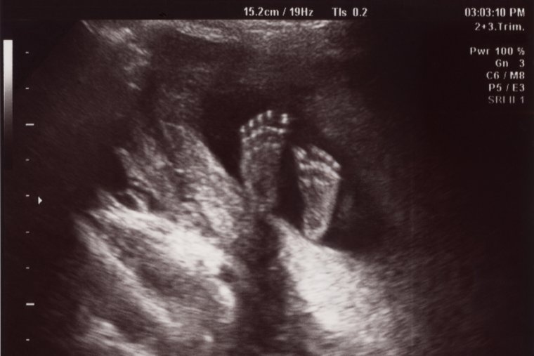 Мемы про УЗИ