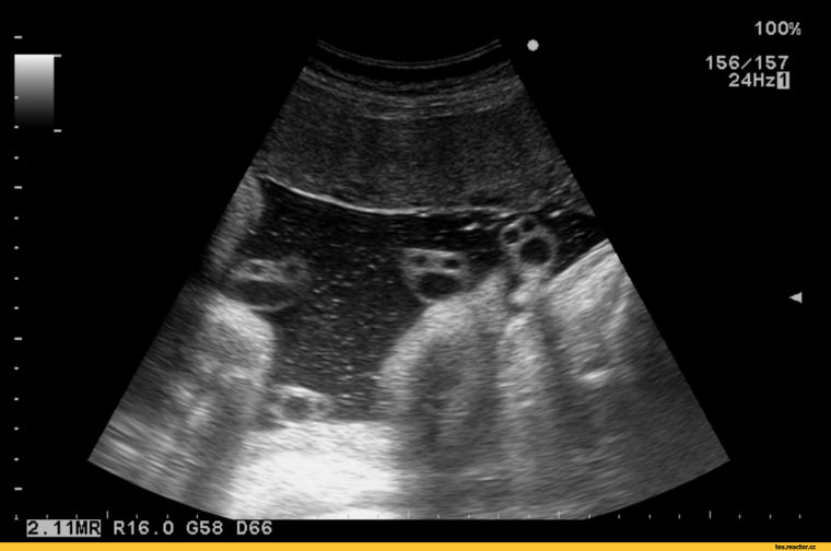 Снимок УЗИ прикол