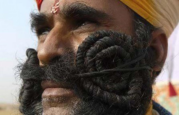 Конгенитальный гипертрихоз