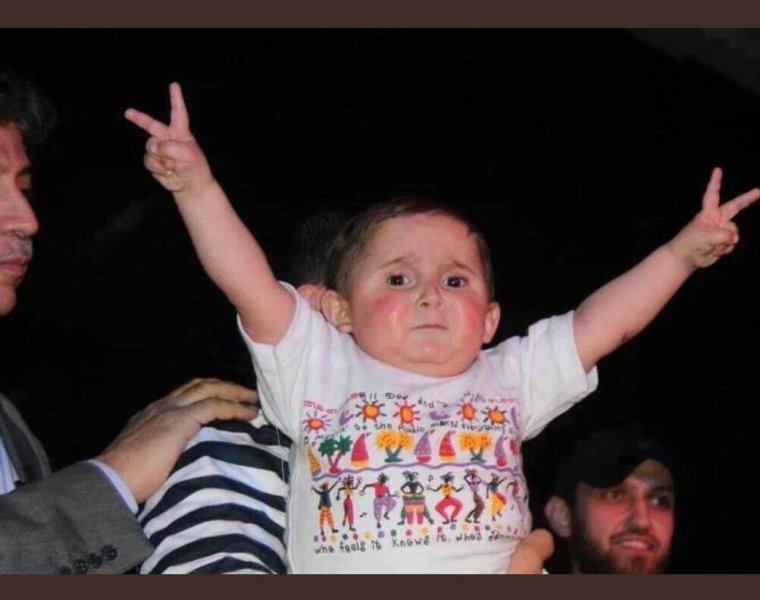 Конгенитальный гипертрихоз