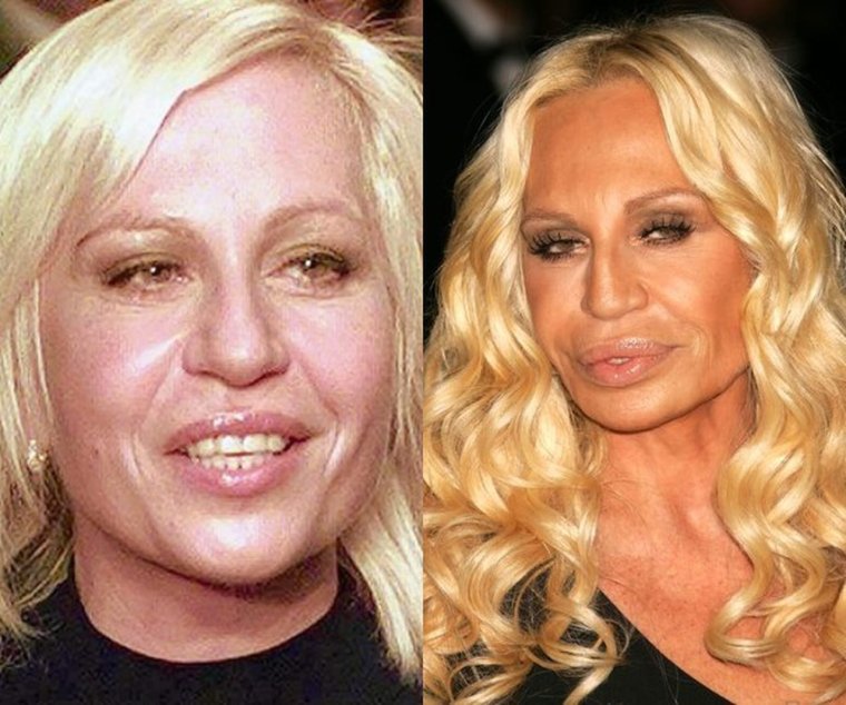 До и после пластической операции