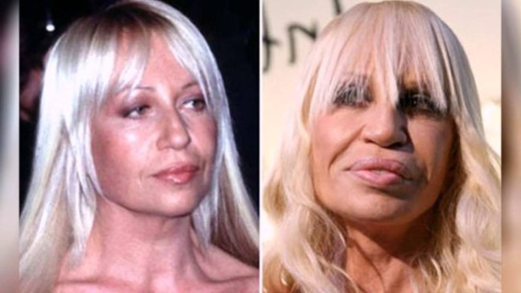 Жертвы пластической хирургии до и после