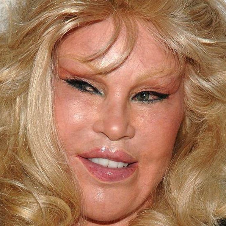 Известные пластических операций губы