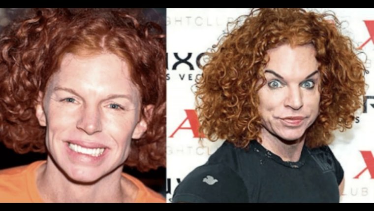 Топ неудачных пластических операций