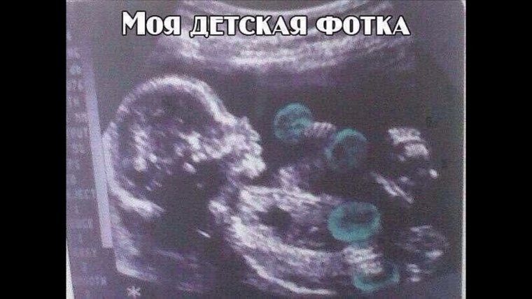 Смешные УЗИ