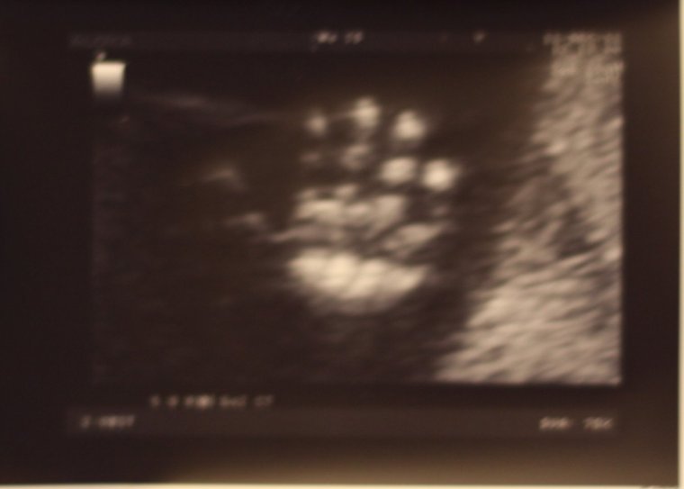 УЗИ ребенка на 25 неделе беременности