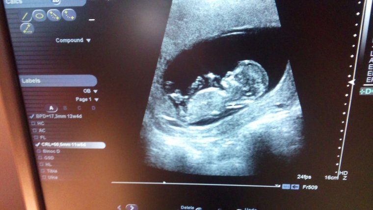 Шутки врача УЗД