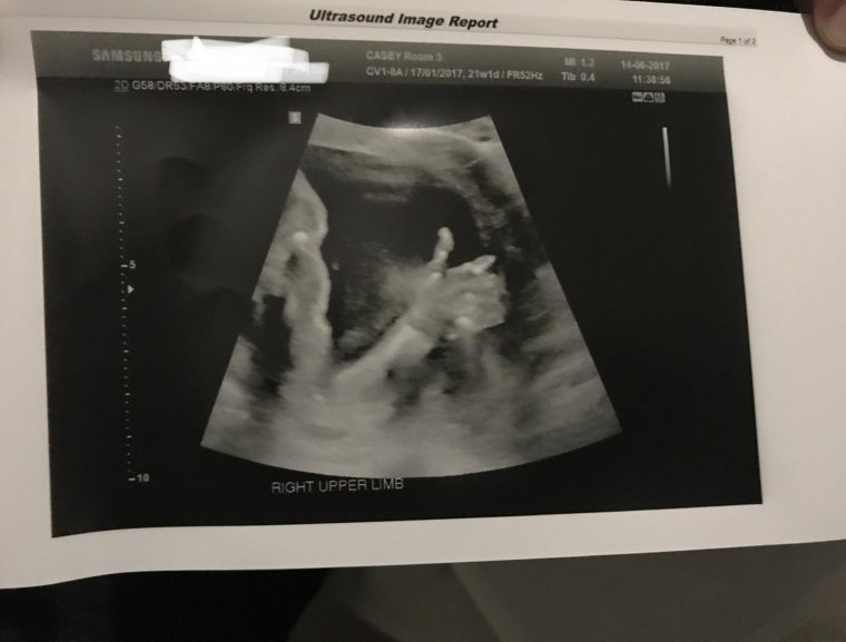 УЗИ простаты