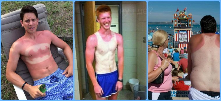 Лысина обгорела на солнце