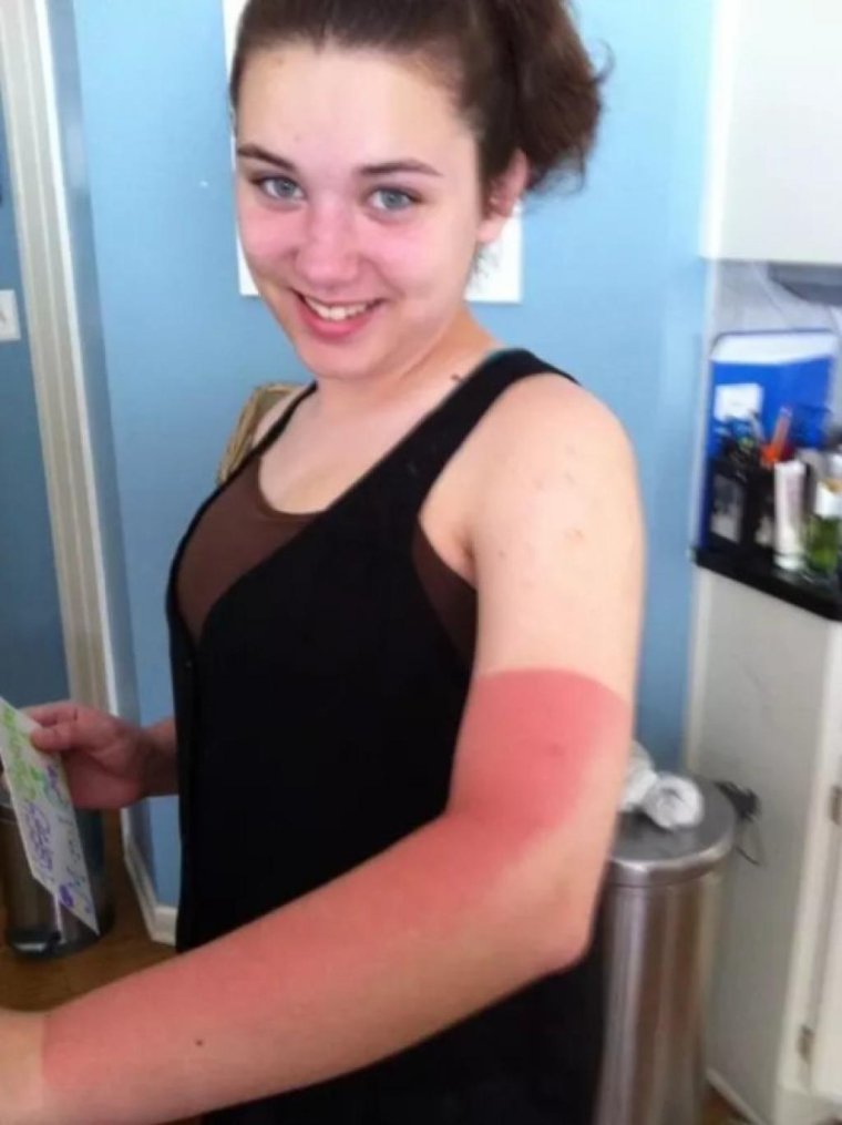 Неудачный загар у девушек