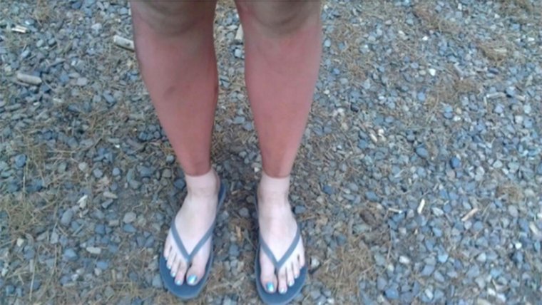 Неудачный загар у девушек