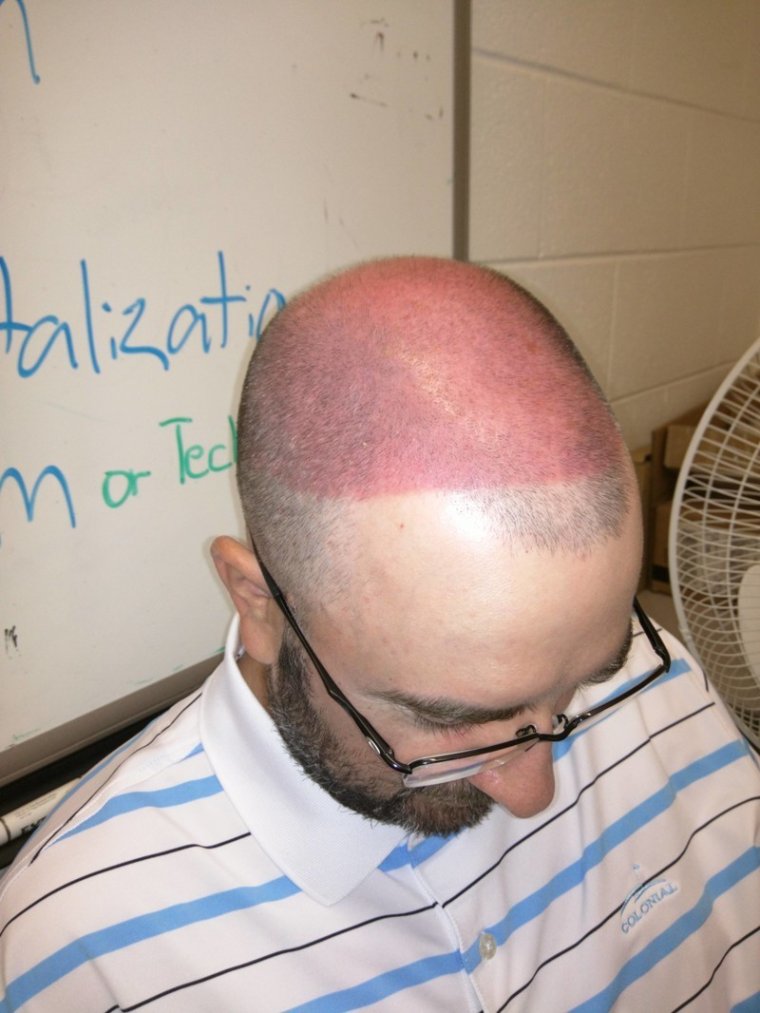 Сильно обгорелый на солнце человек