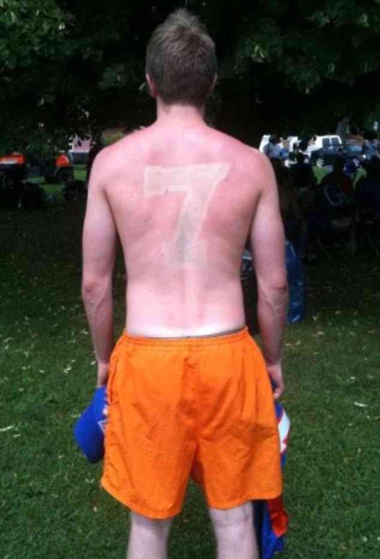 Обгоревшая Татуировка