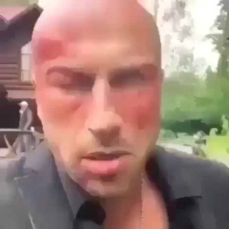 Избитый Дмитрий Нагиев