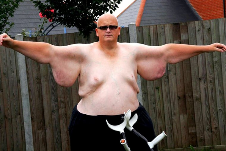 Кожа после похудения весит