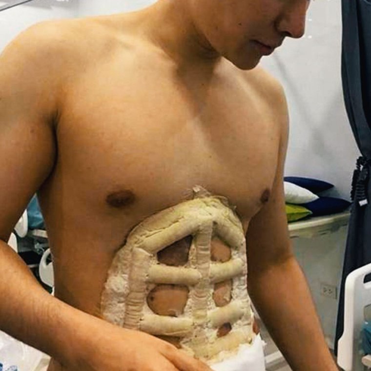 Импланты пресса для мужчин