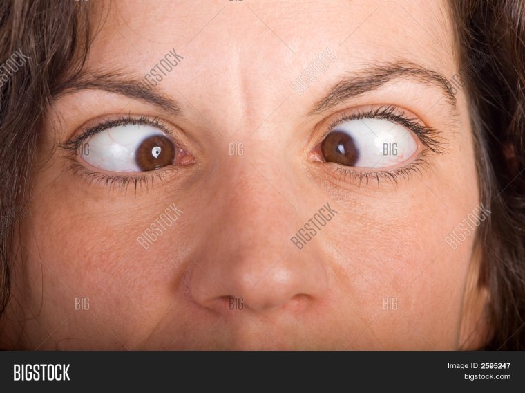 Косоглазие глаза в разные стороны