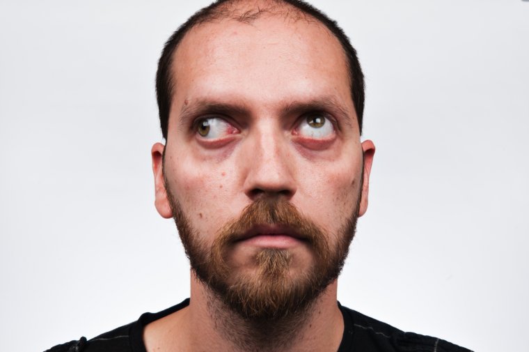 Косоглазие у взрослых