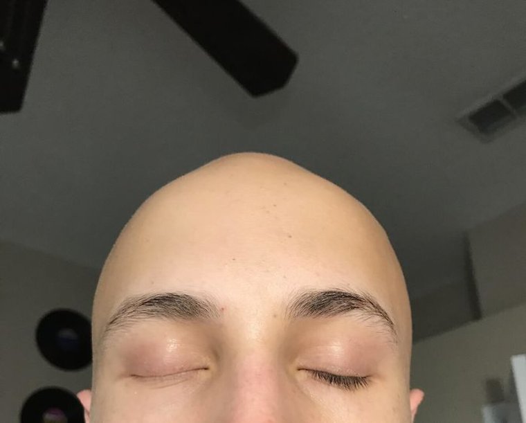 Тотальная алопеция нет ресниц бровей