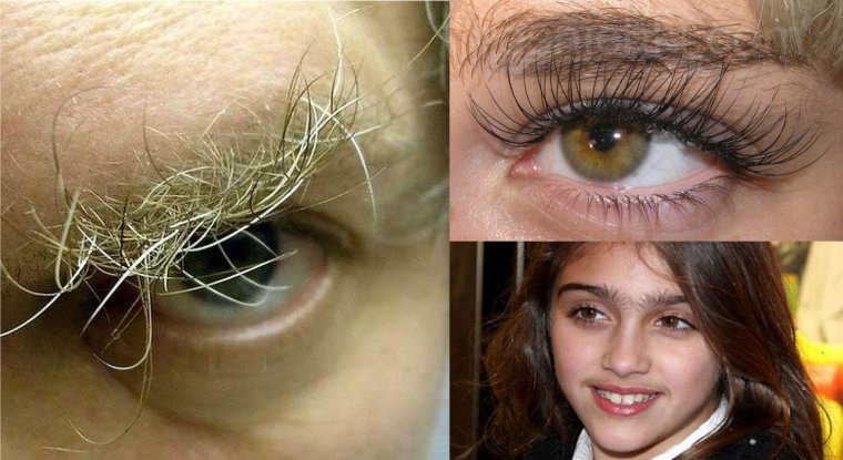 Волосы между бровями