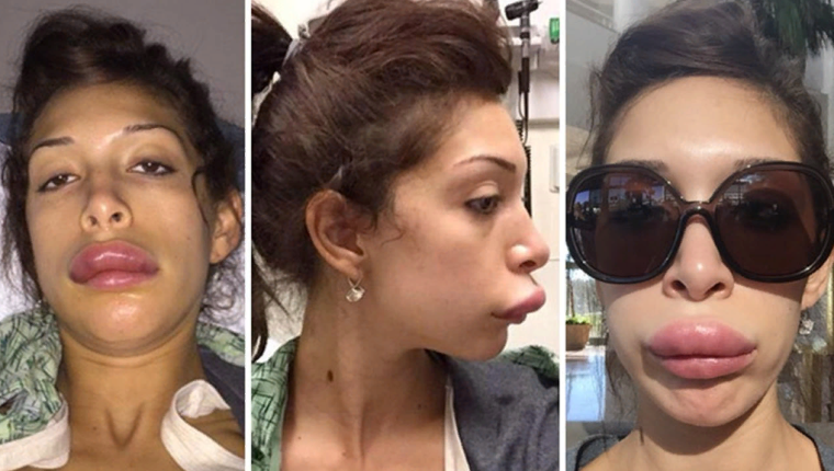 Фарра Абрахам до и после пластики