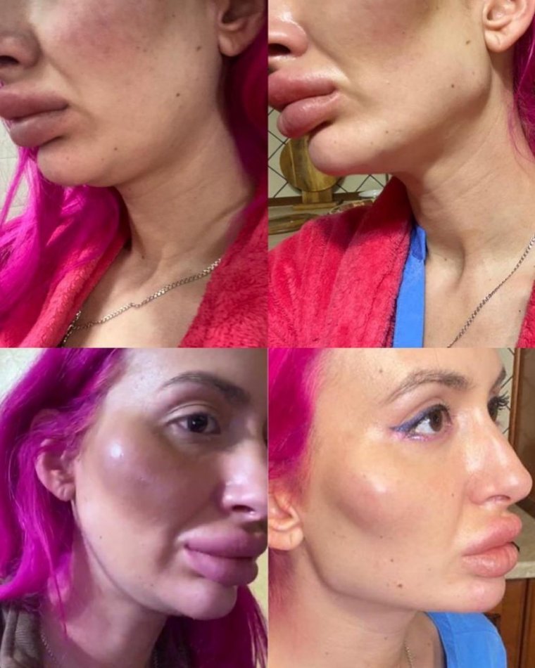 Накаченные скулы ботоксом