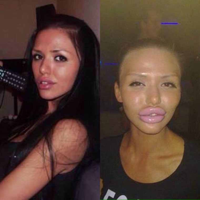 Неудачные губы после пластики