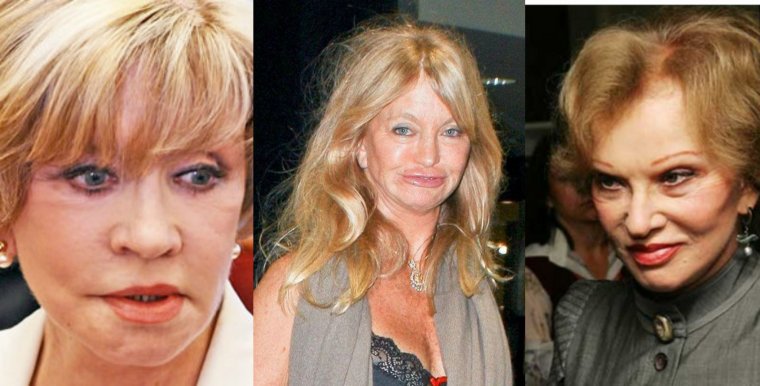 Алентова неудачная пластика