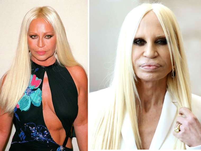 Donatella Versace до пластики