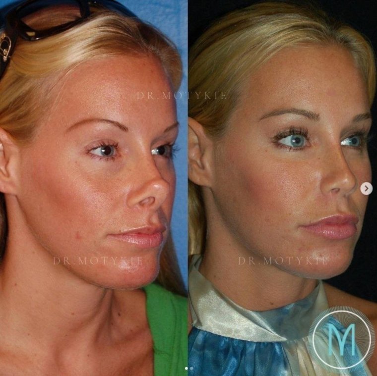 До и после пластики