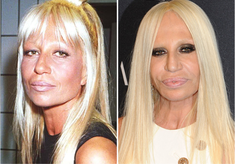 Донателла Версаче неудачная пластика