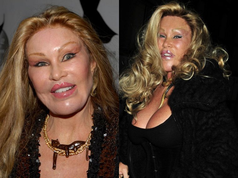 Жертвы пластической хирургии