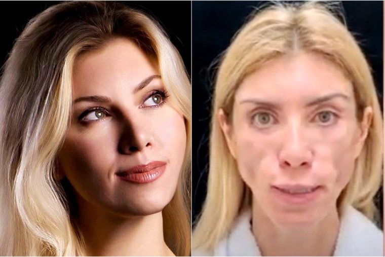 Юлия Тарасевич пластическая операция