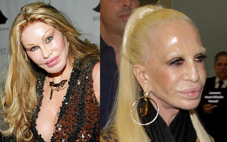 Неудачная ринопластика