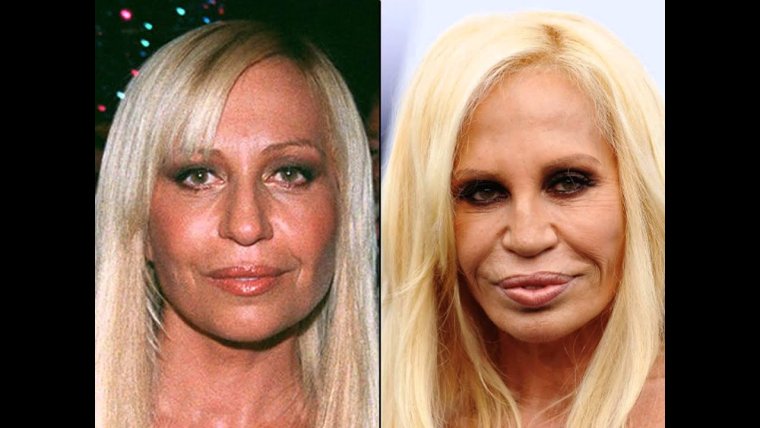 Оксана Самойлова до пластики