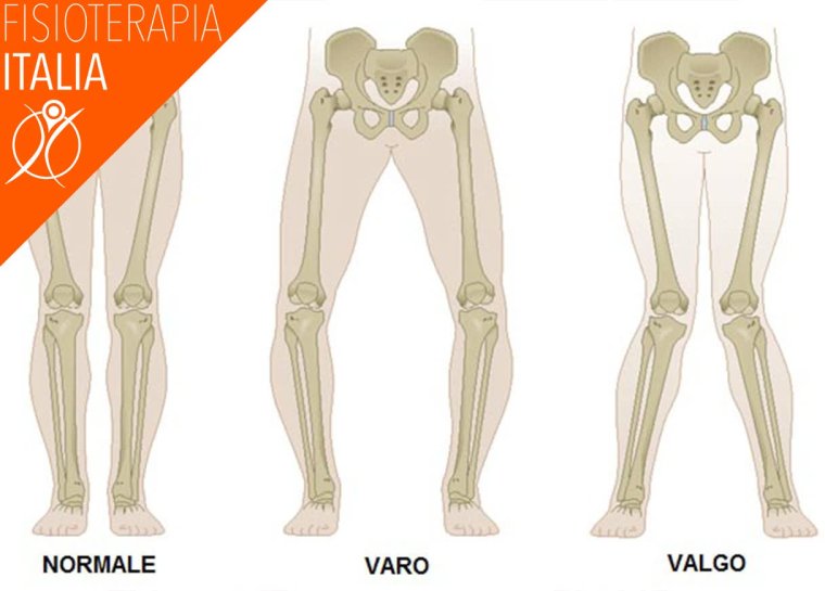 Вальгус тазобедренного сустава